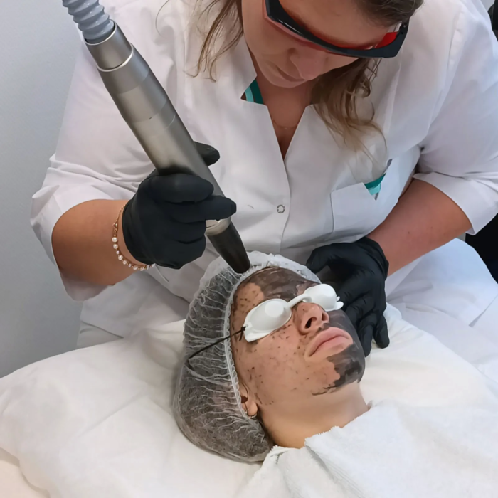 Behandeling met MedAes Carbon Laser Masker voor Huidverbetering met MA506B picolaser