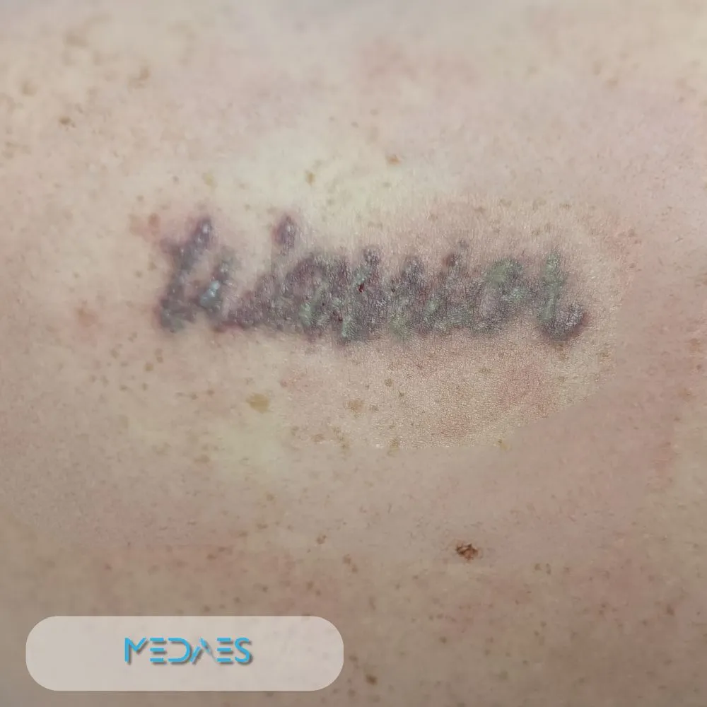 tattoo verwijderen foto voor eerste behandeling