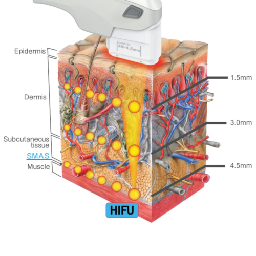 Gold Lift 7D HIFU werking