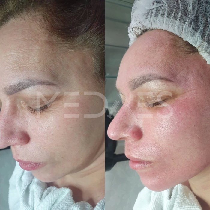 resultaten microneedling direct na bahandeling